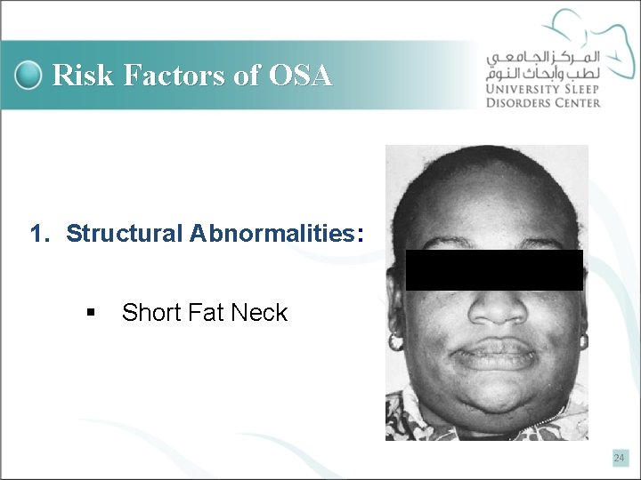 Risk Factors of OSA 1. Structural Abnormalities: § Short Fat Neck 24 