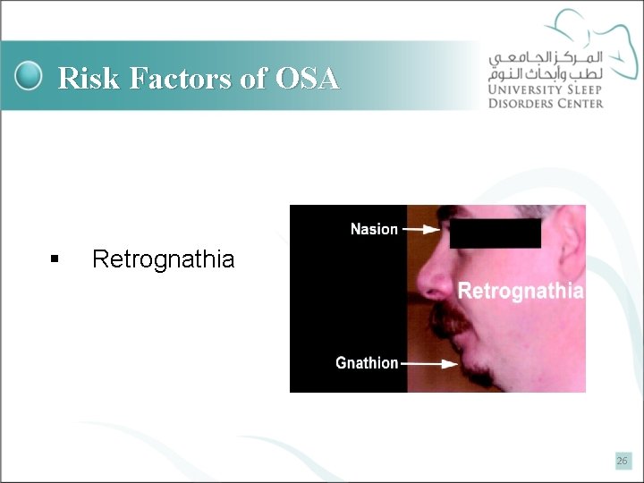 Risk Factors of OSA § Retrognathia 26 