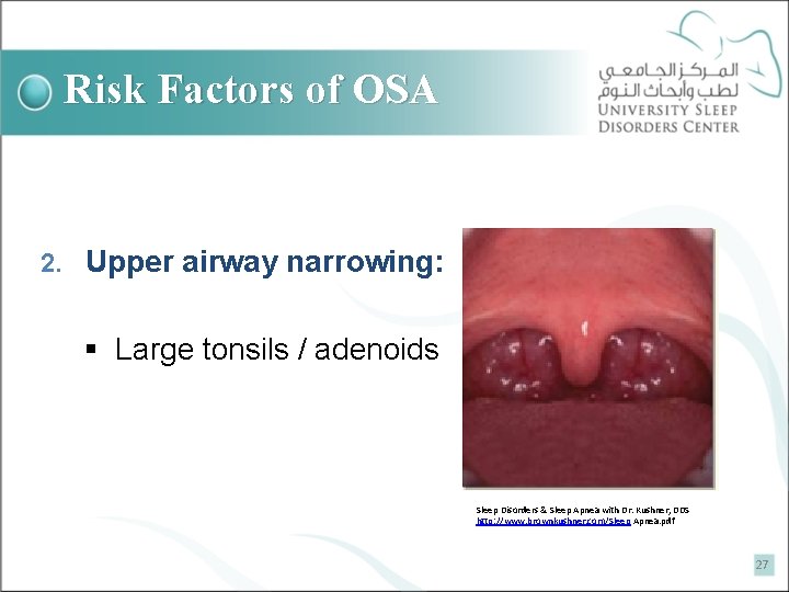 Risk Factors of OSA 2. Upper airway narrowing: § Large tonsils / adenoids Sleep