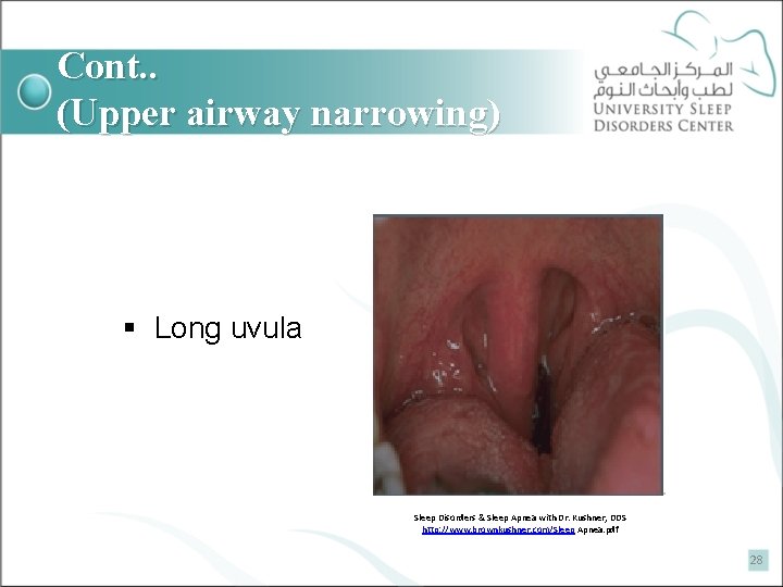 Cont. . (Upper airway narrowing) § Long uvula Sleep Disorders & Sleep Apnea with