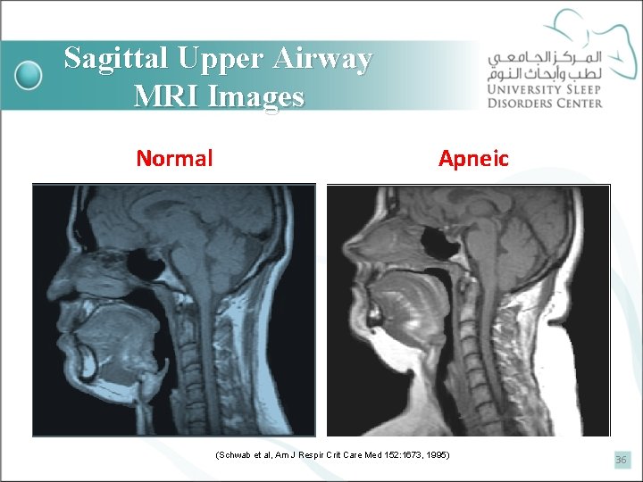Sagittal Upper Airway MRI Images Normal Apneic (Schwab et al, Am J Respir Crit
