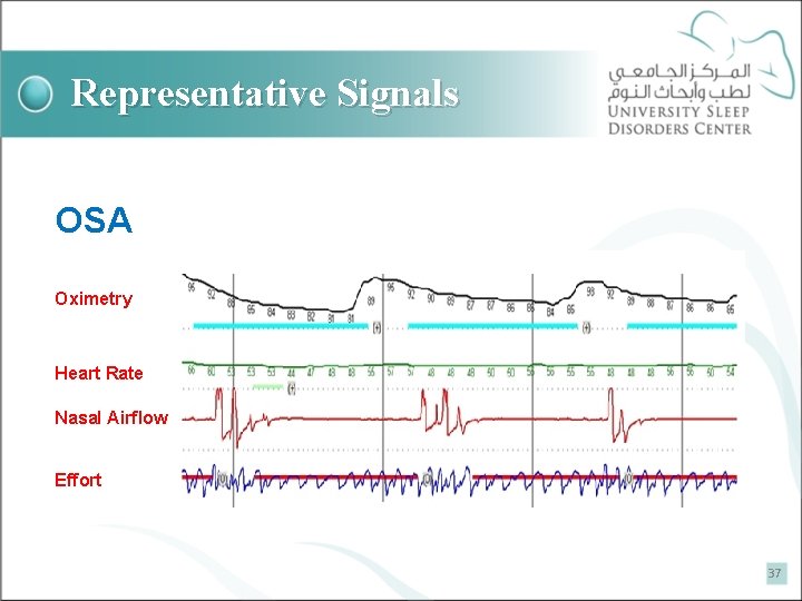 Representative Signals OSA Oximetry Heart Rate Nasal Airflow Effort 37 