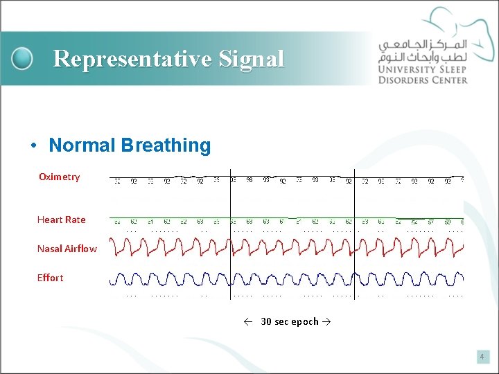 Representative Signal • Normal Breathing Oximetry Heart Rate Nasal Airflow Effort ← 30 sec