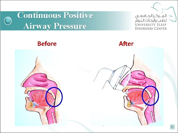 Continuous Positive Airway Pressure Before After 59 
