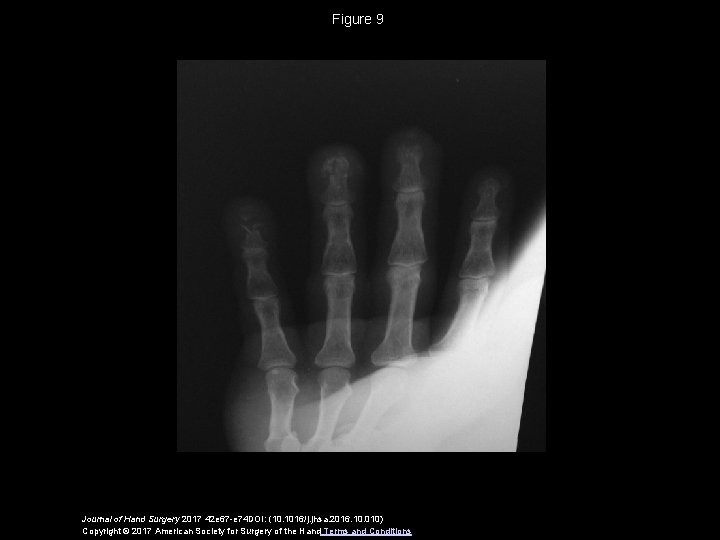 Figure 9 Journal of Hand Surgery 2017 42 e 67 -e 74 DOI: (10.