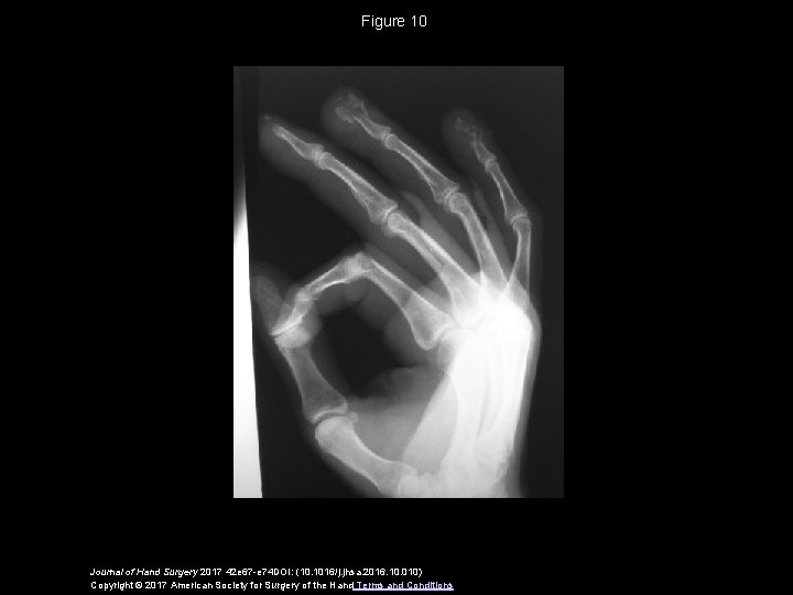 Figure 10 Journal of Hand Surgery 2017 42 e 67 -e 74 DOI: (10.