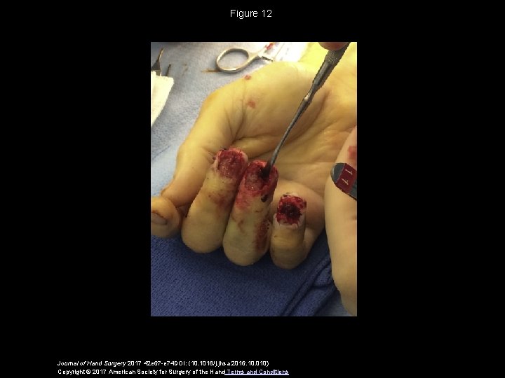 Figure 12 Journal of Hand Surgery 2017 42 e 67 -e 74 DOI: (10.