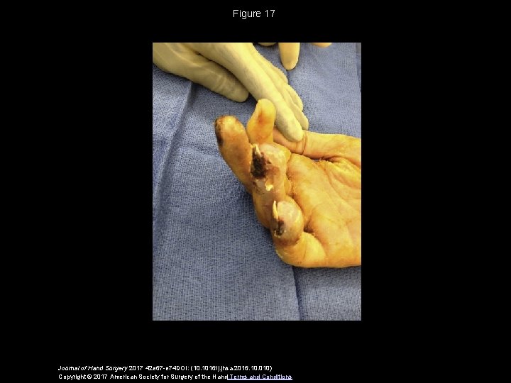 Figure 17 Journal of Hand Surgery 2017 42 e 67 -e 74 DOI: (10.