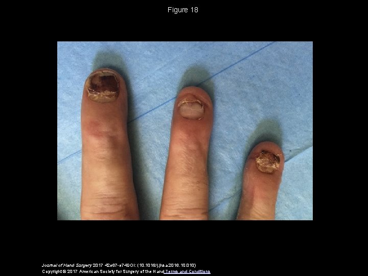 Figure 18 Journal of Hand Surgery 2017 42 e 67 -e 74 DOI: (10.