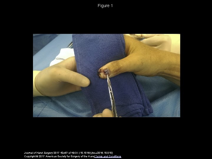 Figure 1 Journal of Hand Surgery 2017 42 e 67 -e 74 DOI: (10.