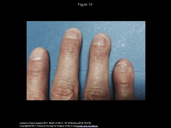 Figure 19 Journal of Hand Surgery 2017 42 e 67 -e 74 DOI: (10.