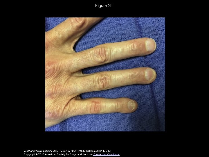 Figure 20 Journal of Hand Surgery 2017 42 e 67 -e 74 DOI: (10.