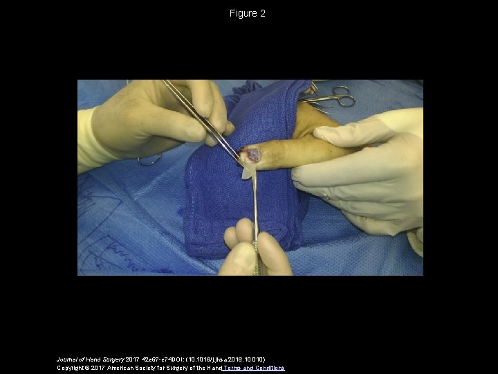 Figure 2 Journal of Hand Surgery 2017 42 e 67 -e 74 DOI: (10.