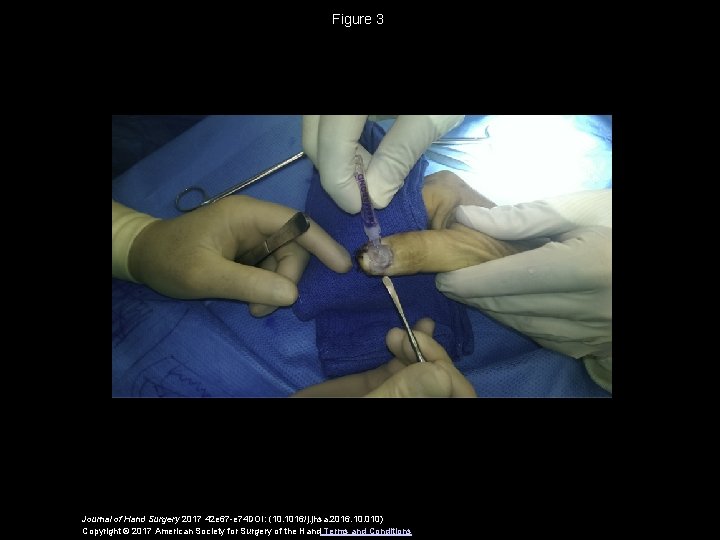 Figure 3 Journal of Hand Surgery 2017 42 e 67 -e 74 DOI: (10.