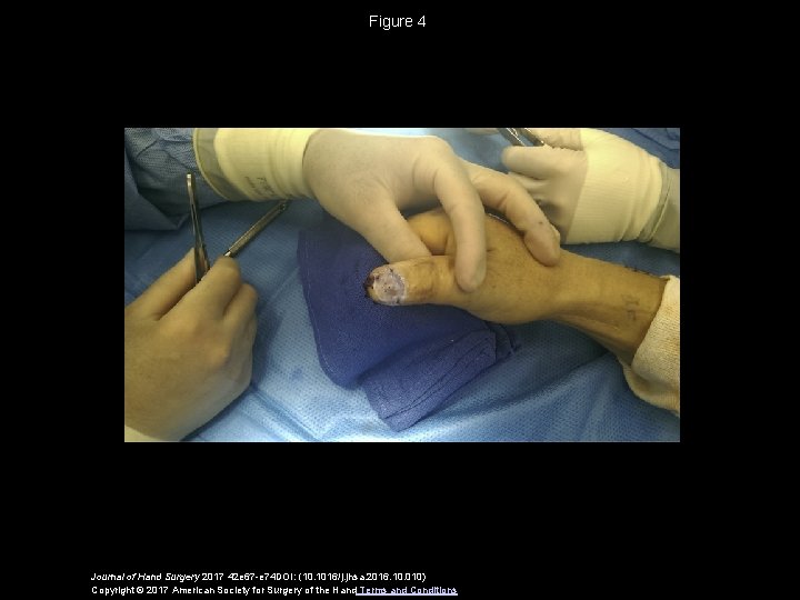 Figure 4 Journal of Hand Surgery 2017 42 e 67 -e 74 DOI: (10.