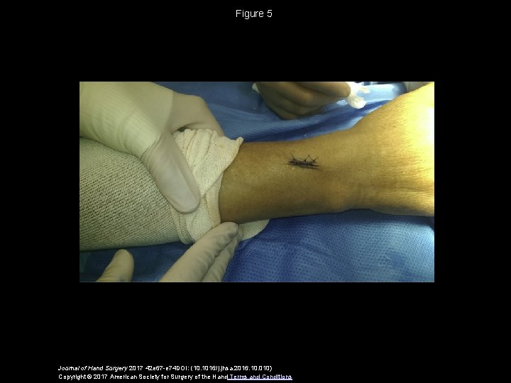 Figure 5 Journal of Hand Surgery 2017 42 e 67 -e 74 DOI: (10.