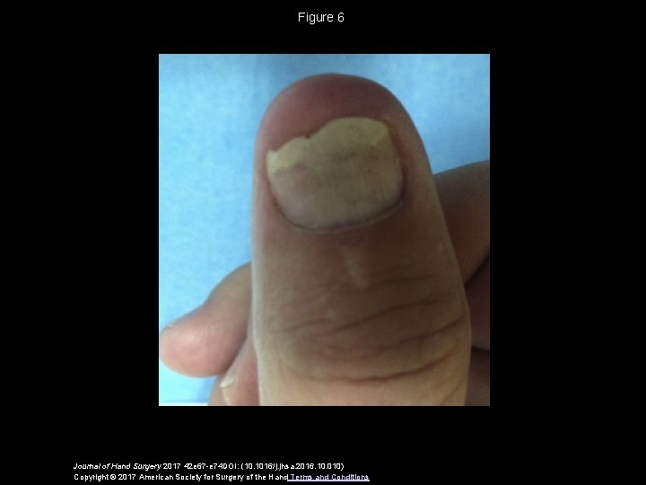 Figure 6 Journal of Hand Surgery 2017 42 e 67 -e 74 DOI: (10.