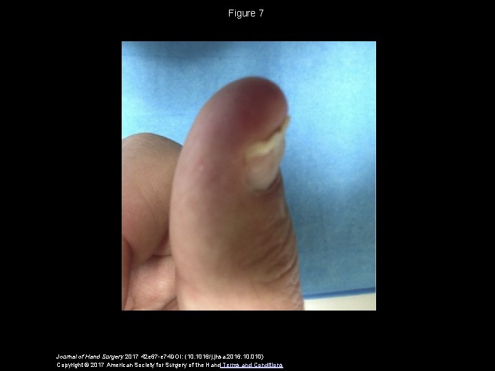 Figure 7 Journal of Hand Surgery 2017 42 e 67 -e 74 DOI: (10.