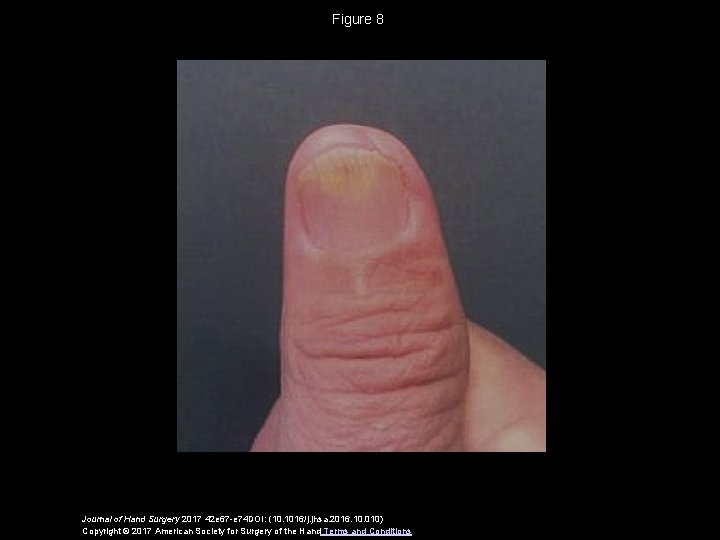 Figure 8 Journal of Hand Surgery 2017 42 e 67 -e 74 DOI: (10.