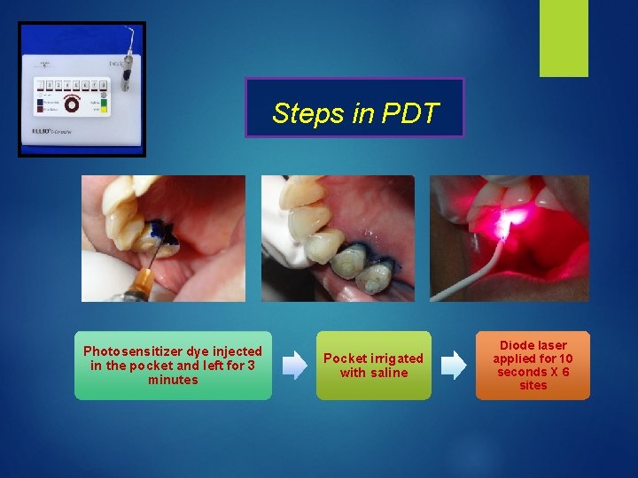 Steps in PDT Photosensitizer dye injected in the pocket and left for 3 minutes