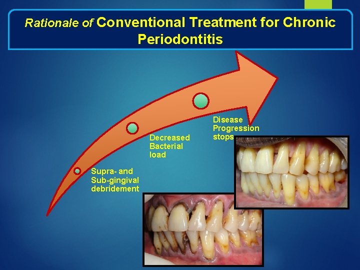 Rationale of Conventional Treatment for Chronic Periodontitis Decreased Bacterial load Supra- and Sub-gingival debridement
