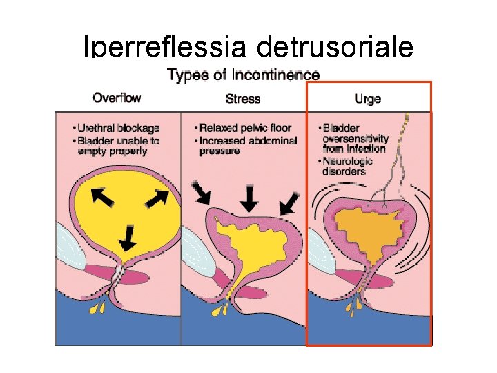 Iperreflessia detrusoriale 