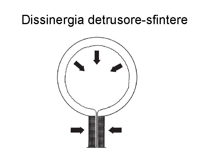 Dissinergia detrusore-sfintere 