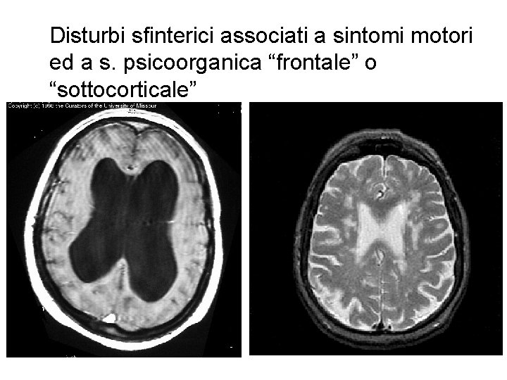 Disturbi sfinterici associati a sintomi motori ed a s. psicoorganica “frontale” o “sottocorticale” 