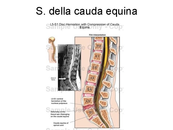 S. della cauda equina 