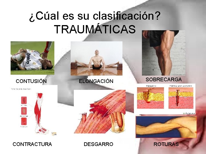 ¿Cúal es su clasificación? TRAUMÁTICAS CONTUSIÓN CONTRACTURA ELONGACIÓN DESGARRO SOBRECARGA ROTURAS 