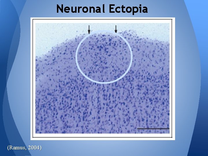 Neuronal Ectopia (Ramus, 2004) 
