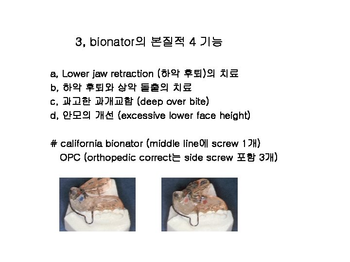 3, bionator의 본질적 4 기능 a, Lower jaw retraction (하악 후퇴)의 치료 b, 하악