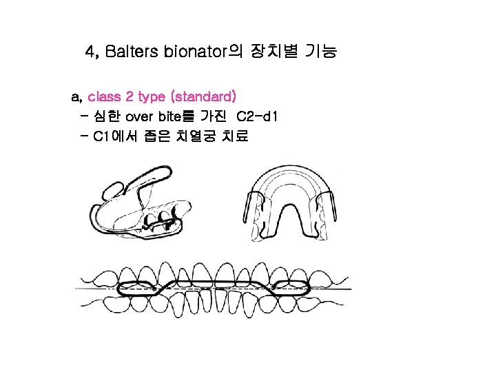 4, Balters bionator의 장치별 기능 a, class 2 type (standard) - 심한 over bite를
