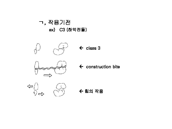 ㄱ, 작용기전 ex) C 3 (하악전돌) class 3 construction bite 힘의 작용 