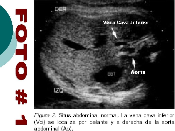 Vena Cava Inferior Aorta 