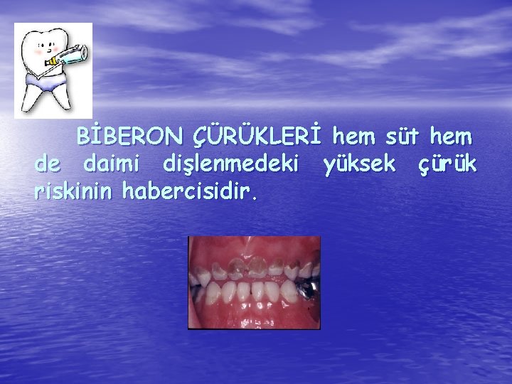 BİBERON ÇÜRÜKLERİ hem süt hem de daimi dişlenmedeki yüksek çürük riskinin habercisidir. 