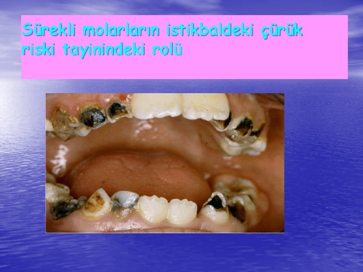 Sürekli molarların istikbaldeki çürük riski tayinindeki rolü 