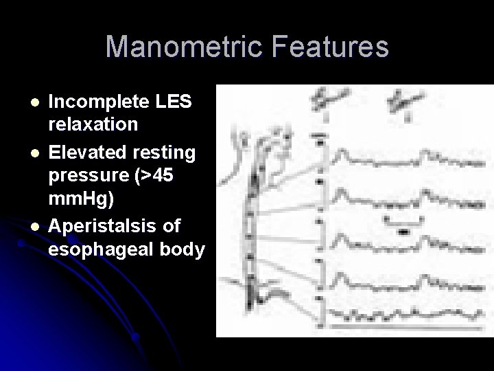 Manometric Features l l l Incomplete LES relaxation Elevated resting pressure (>45 mm. Hg)