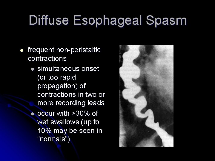 Diffuse Esophageal Spasm l frequent non-peristaltic contractions l simultaneous onset (or too rapid propagation)