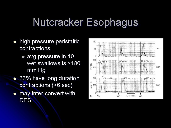 Nutcracker Esophagus l l l high pressure peristaltic contractions l avg pressure in 10