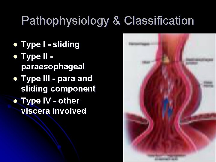 Pathophysiology & Classification l l Type I - sliding Type II paraesophageal Type III