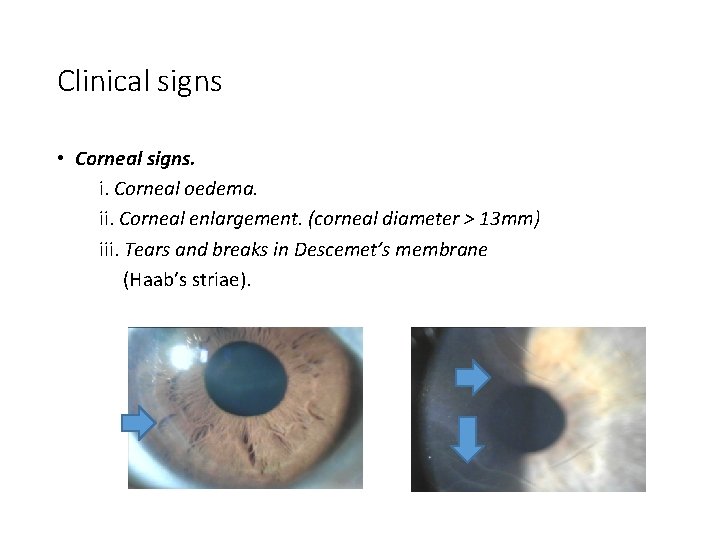Clinical signs • Corneal signs. i. Corneal oedema. ii. Corneal enlargement. (corneal diameter >