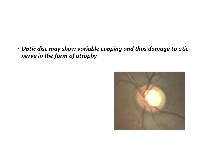  • Optic disc may show variable cupping and thus damage to otic nerve