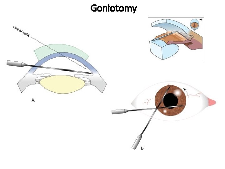 Goniotomy 