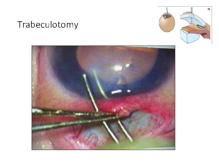 Trabeculotomy 