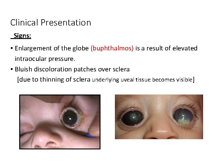 Clinical Presentation Signs: • Enlargement of the globe (buphthalmos) is a result of elevated