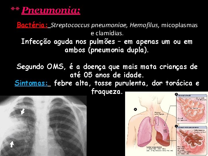 ** Pneumonia: Bactéria: Streptococcus pneumoniae, Hemofilus, micoplasmas e clamídias. Infecção aguda nos pulmões –