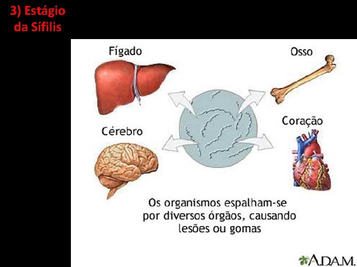 3) Estágio da Sífilis 