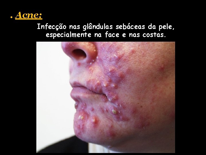 . Acne: Infecção nas glândulas sebáceas da pele, especialmente na face e nas costas.