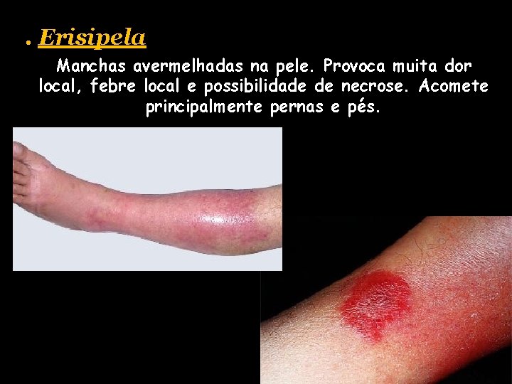 . Erisipela Manchas avermelhadas na pele. Provoca muita dor local, febre local e possibilidade